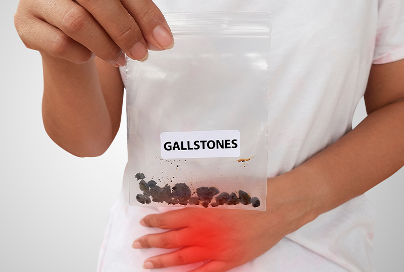 Complete Gall Stones Treatment