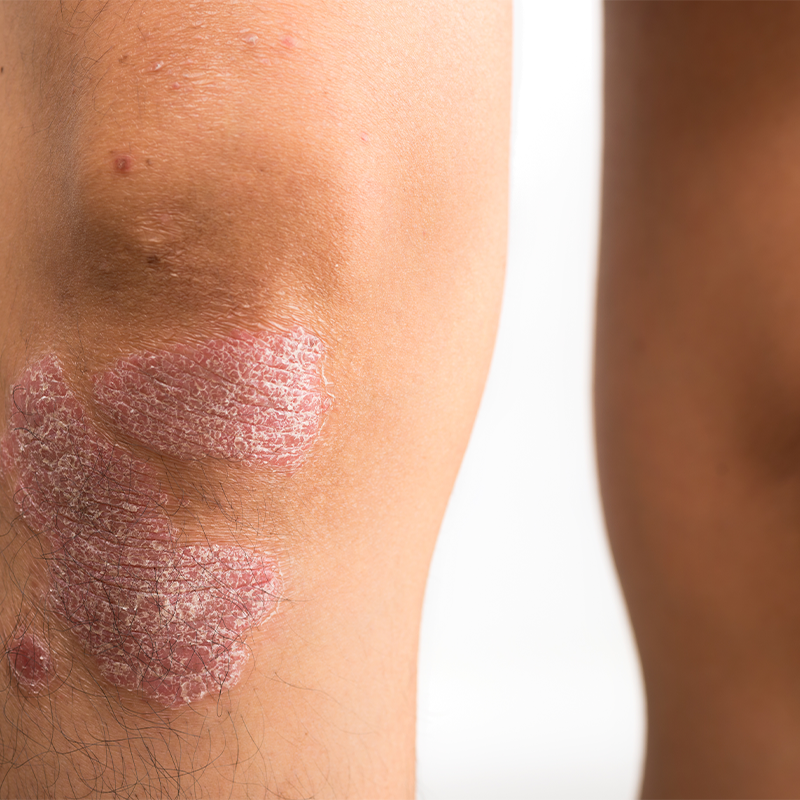 joint skin affected by skin disease Psoriasis skin care